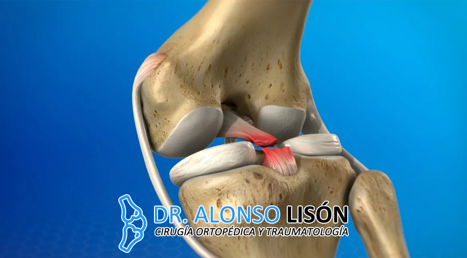 Recuperación del ligamento cruzado anterior - DR BALLESTER- TRAUMATOLOGIA  CIRUGIA ORTOPEDICA