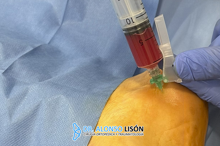 El suero rico en citoquinas (SARC) es un suero libre de células obtenido a partir de la sangre del propio paciente a través de un sistema de bioingienería llamado Qrem Cytokine.